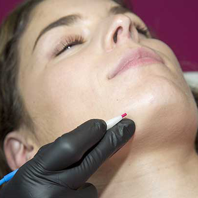 Techniques d'Epilation Definitive