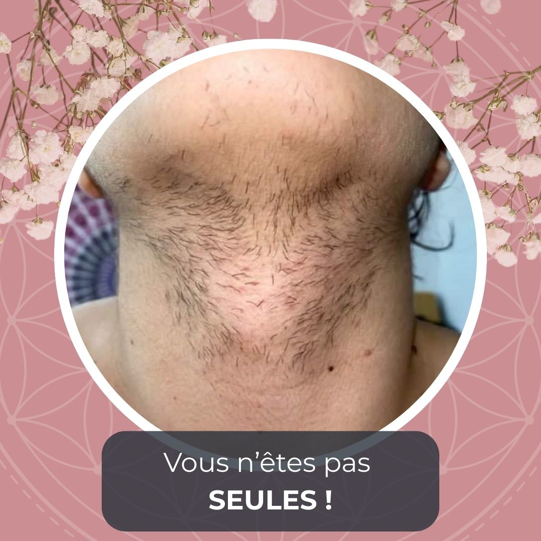 SOPK & Hirsutisme : reprendre confiance en soi grâce à l'Épilation Définitive